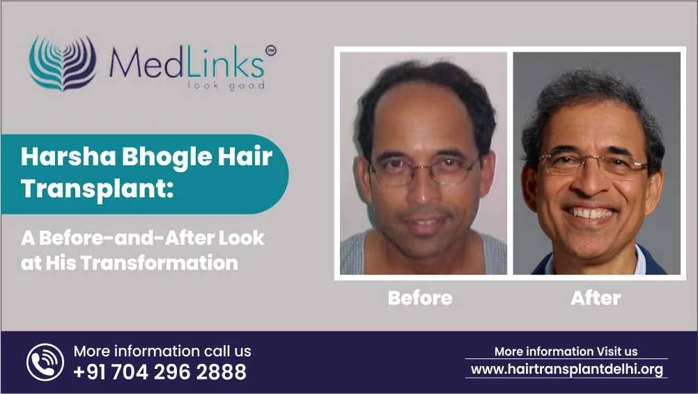 hair transplant in india