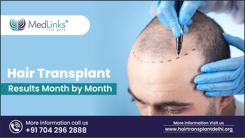 Hair Transplant Results Month by Month