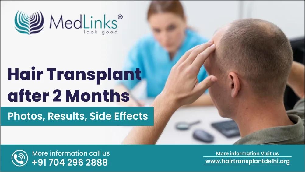 Hair Transplant after 2 Months: Photos, Results, Side Effects
