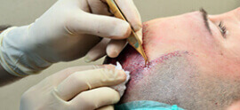 6 Myths Associated with Hair Restoration Surgery