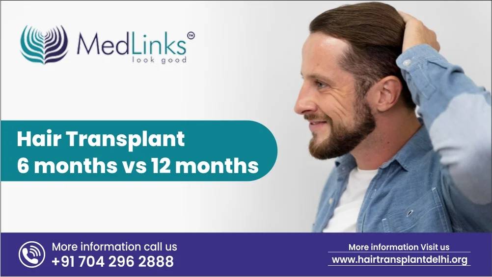 Hair Transplant 6 Months vs 12 Months