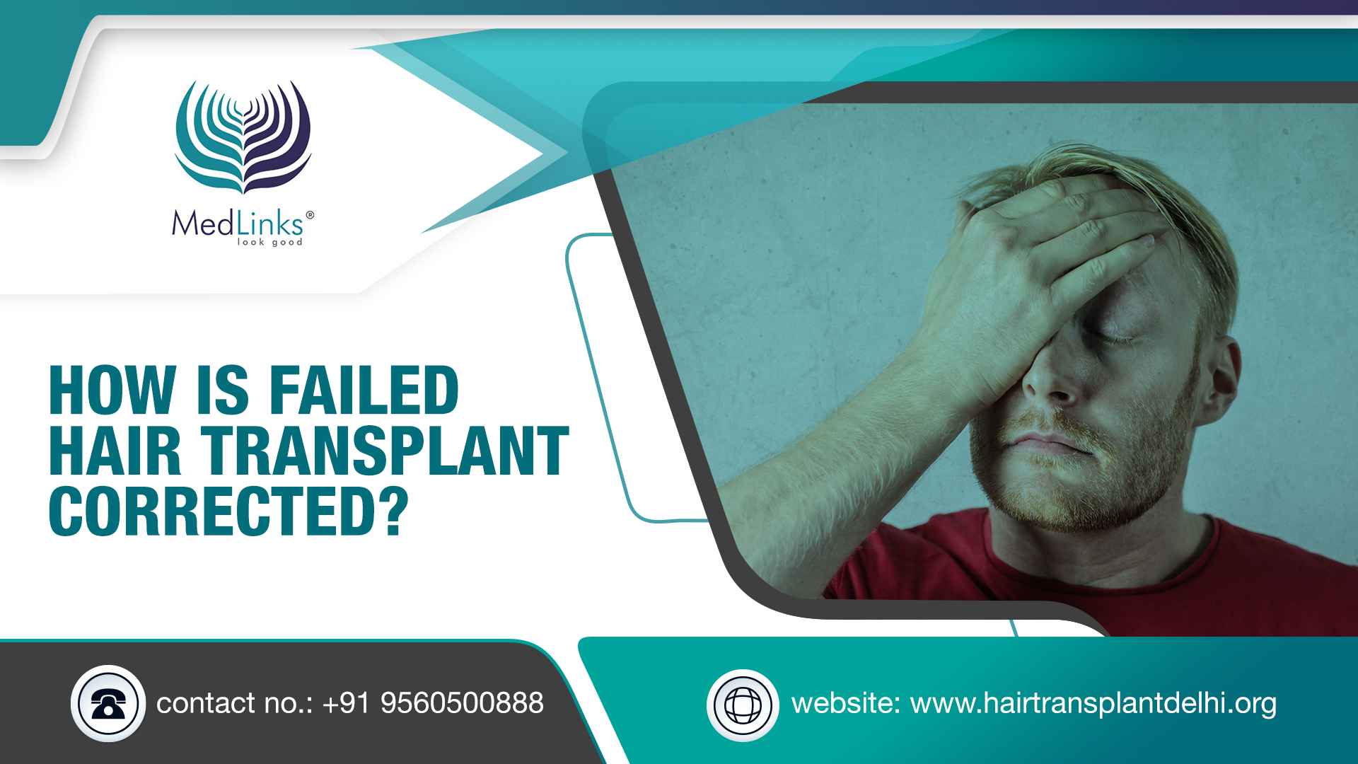 How is Failed Hair Transplant Corrected?