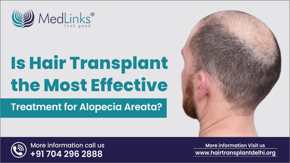 Is Hair Transplant the Most Effective Treatment for Alopecia Areata?