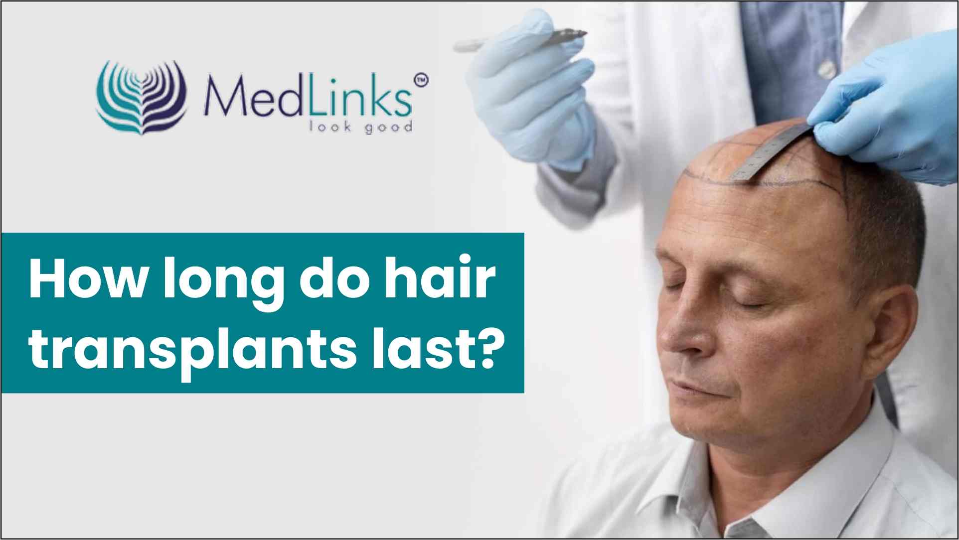 How long do hair transplants last? | Medlinks