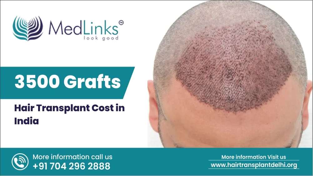 3500 Grafts Hair Transplant Cost in India 2024| Medlinks