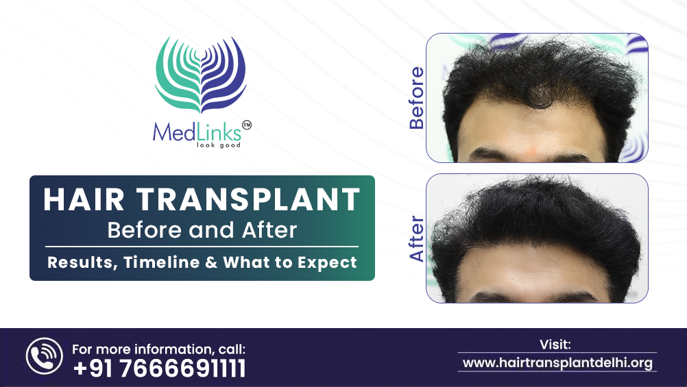hair transplant in india
