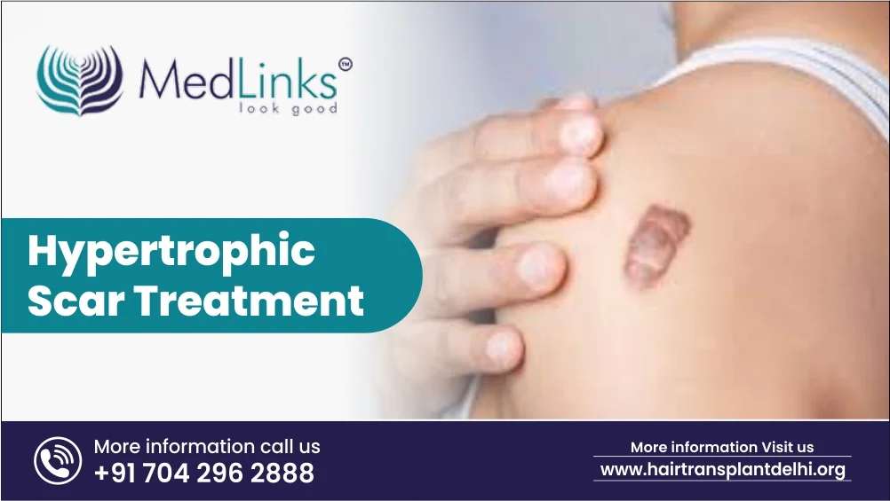 How Does Hypertrophic Scar Treatment Work?