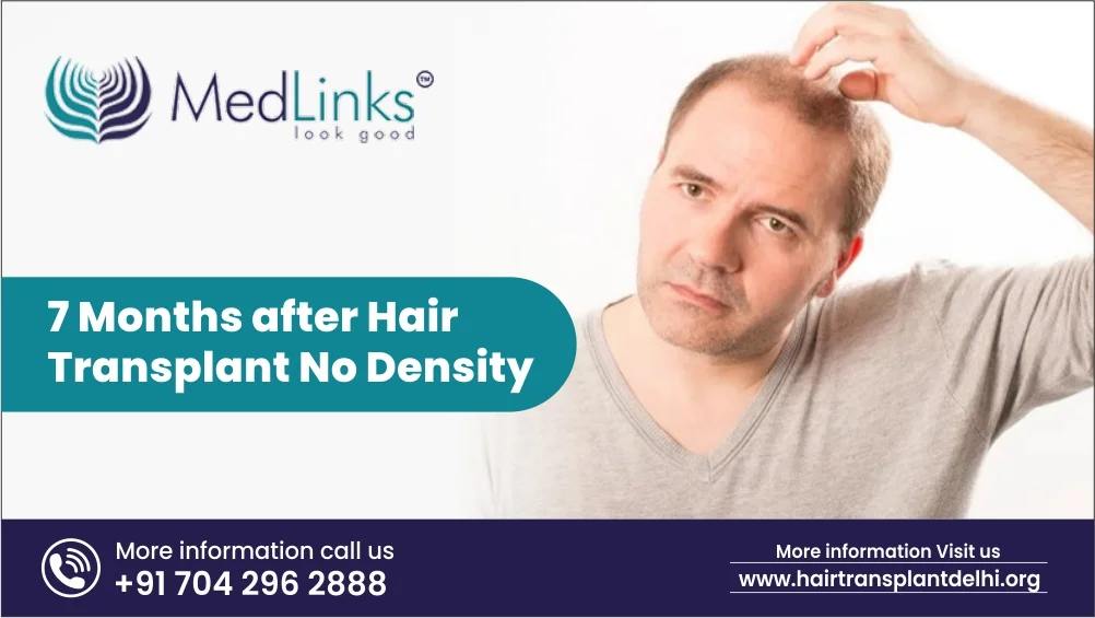 7 Months After Hair Transplant No Density
