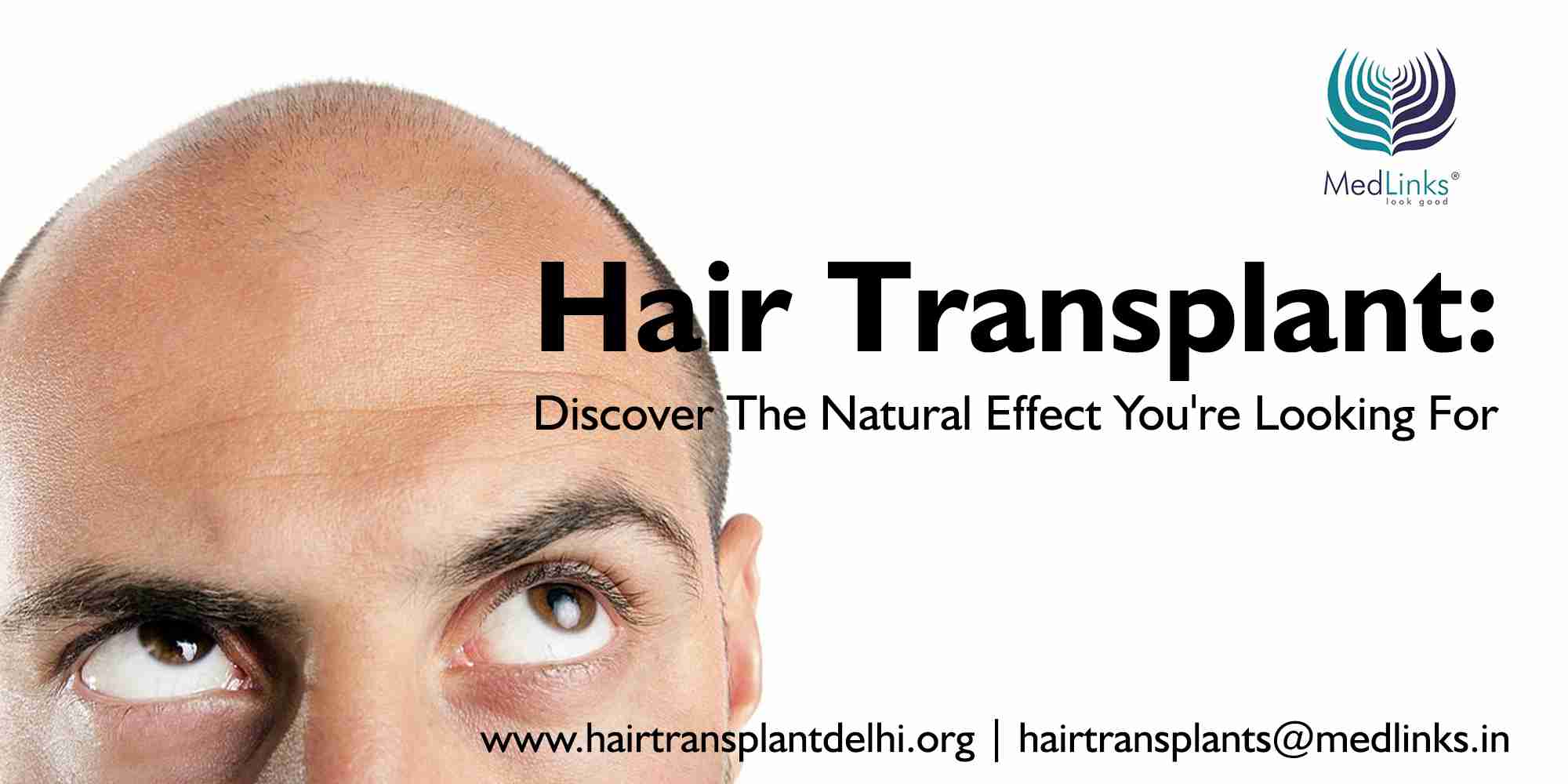 Best Hair Transplant Clinic in Delhi, Cost of Hair Transplant