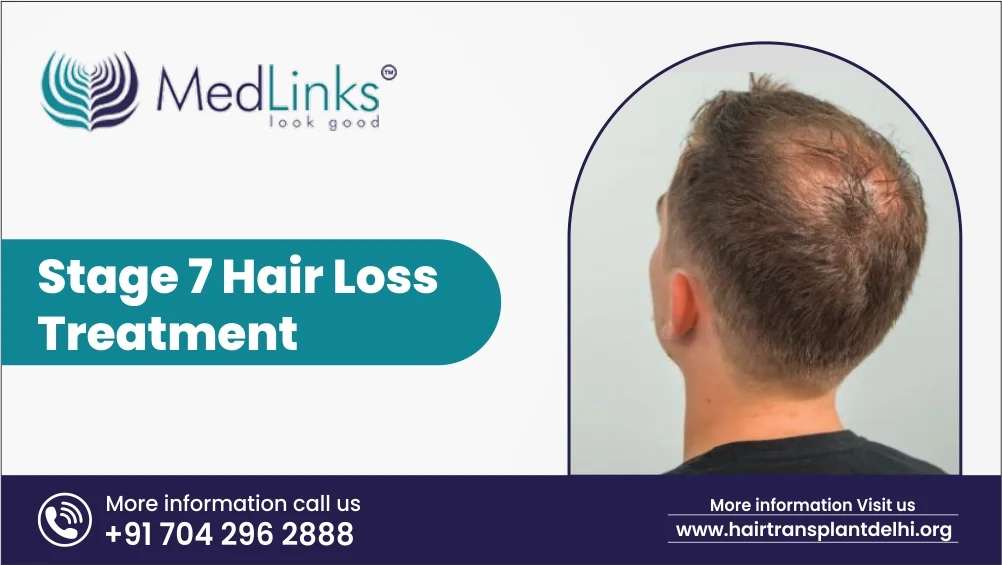 Stage 7 Hair Loss Treatments
