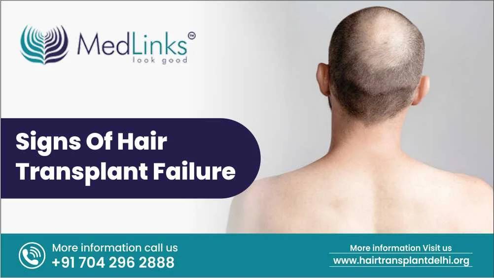 Signs of Hair Transplant Failure