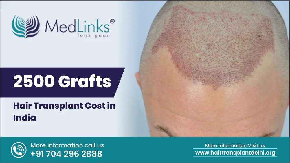2500 Grafts Hair Transplant Cost in India 2024