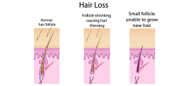 Different stages of hair loss! When to see a hair specialist?