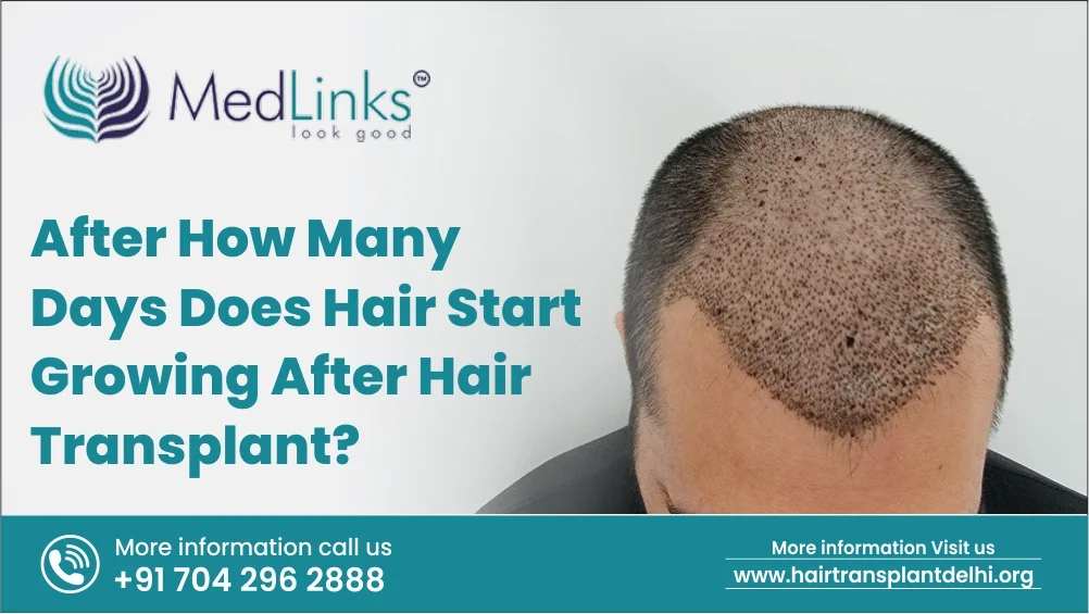 hair transplant in india