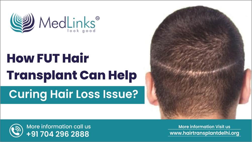 How FUT Hair Transplant Can Help Curing Hair Loss Issue?