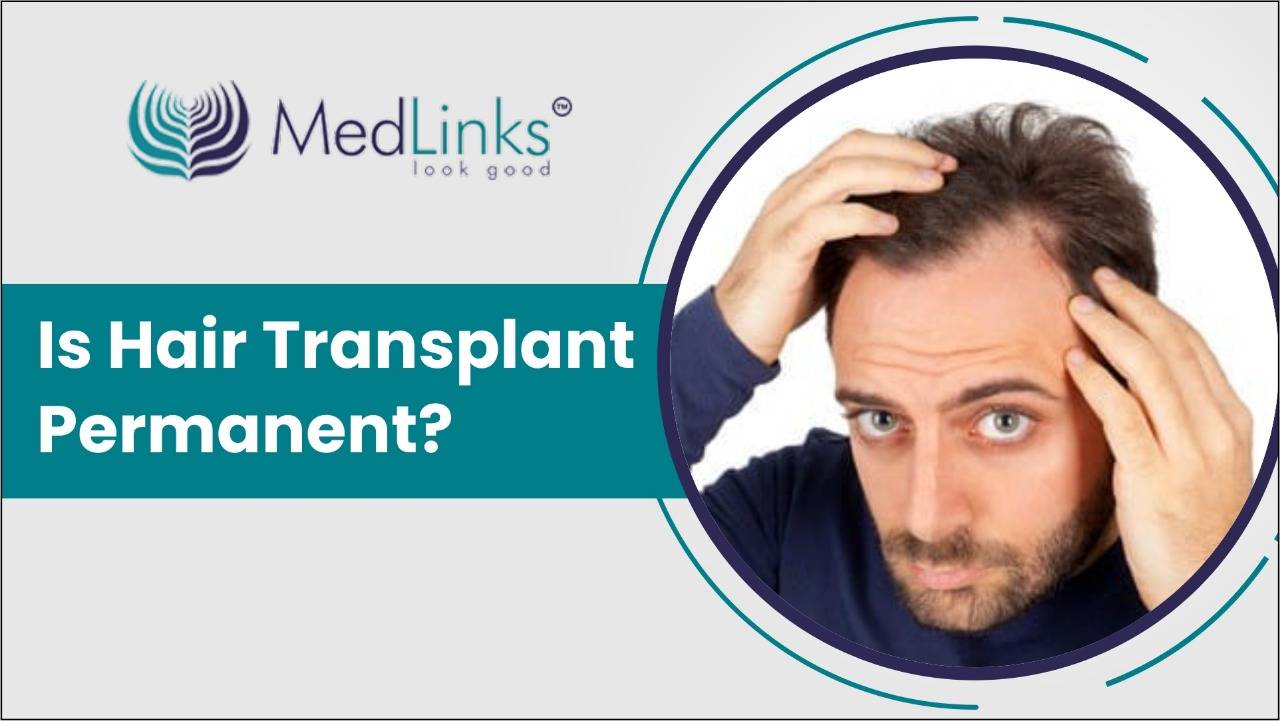 Is Hair Transplant Permanent? Do They Last Forever? - Medlinks