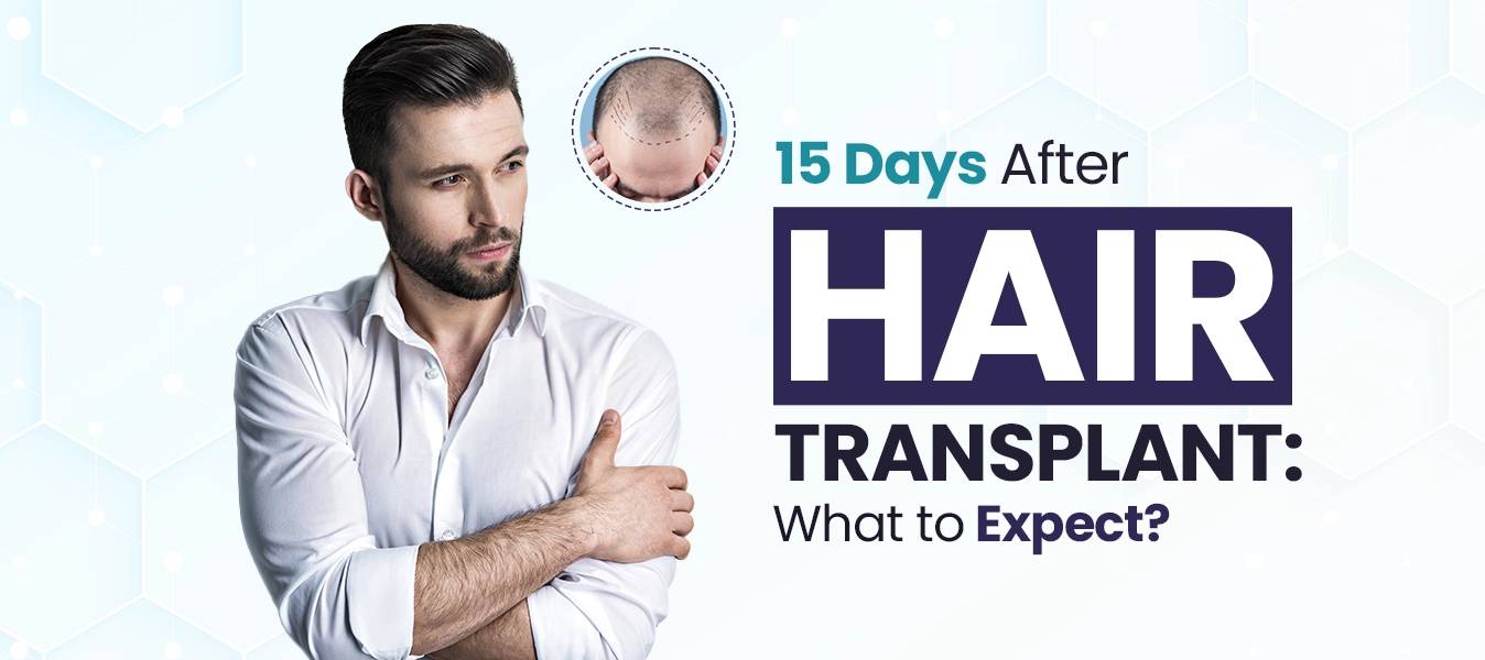 hair transplant in india