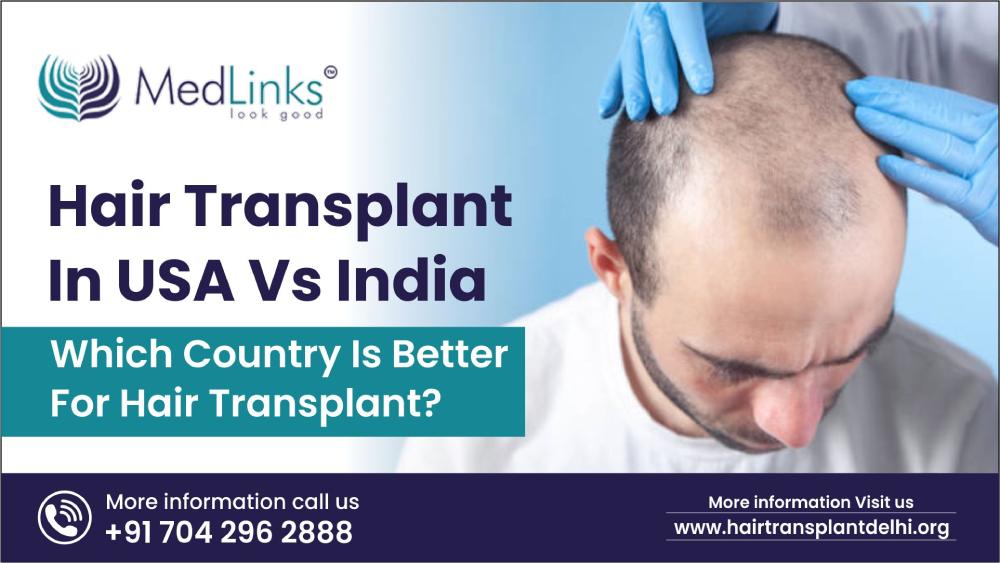 Hair Transplant USA Vs India