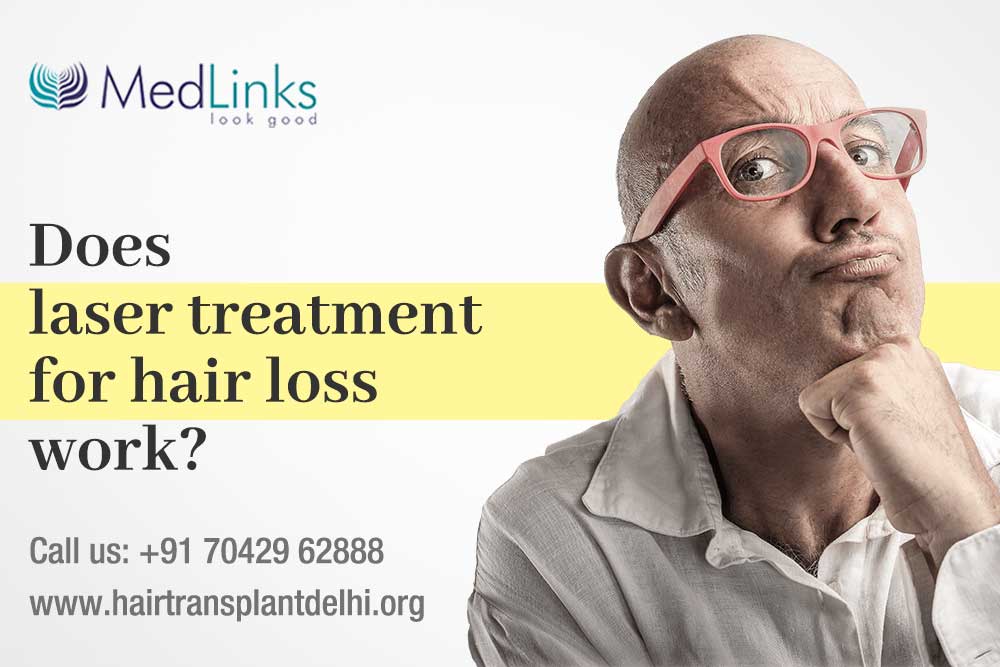 Laser Treatment For Hair Loss- Does It Work?