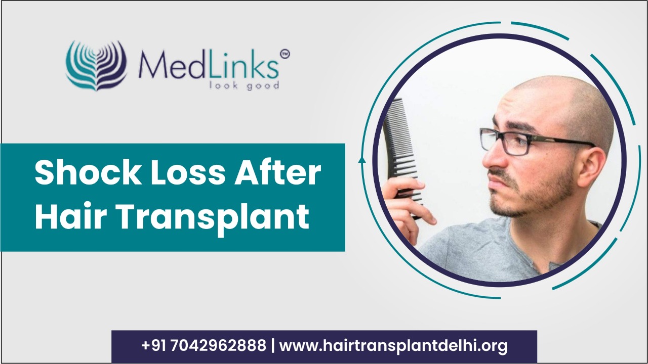 Shock Loss After Hair Transplant | Medlinks