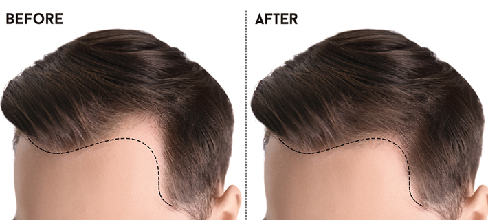 Natural fair density result from a female hair transplant