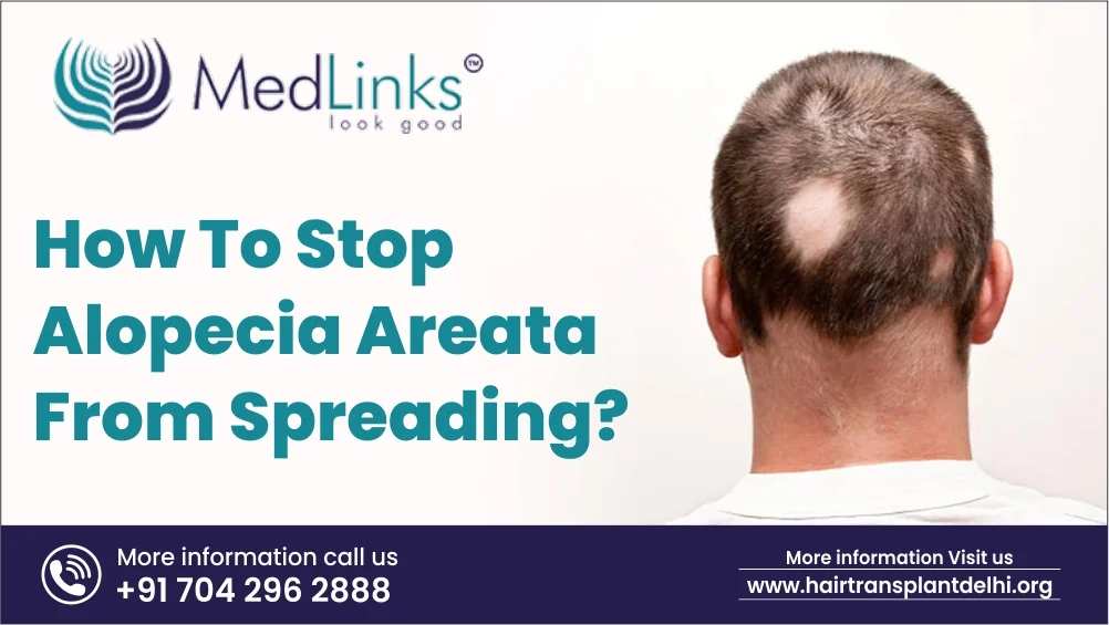 How To Stop Alopecia Areata From Spreading?