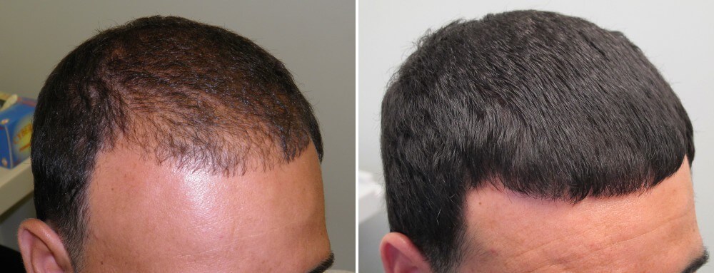 Pick the Right Hair Loss Treatment