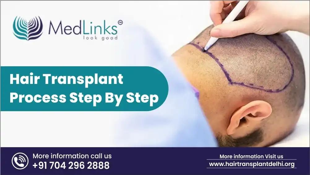 Hair Transplant Process Step by Step