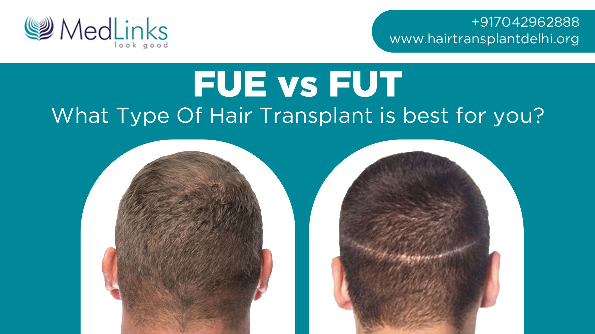 FUE vs. FUT: What Type of Hair Transplant is Best for you? | MedLinks
