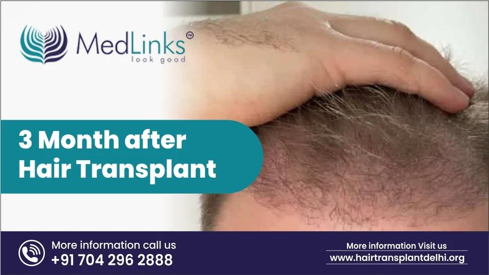 3 Months After Hair Transplant