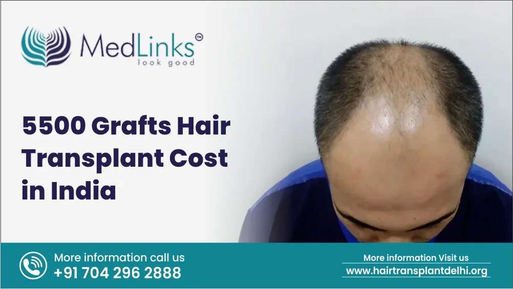 5500 Grafts Hair Transplant Cost in India