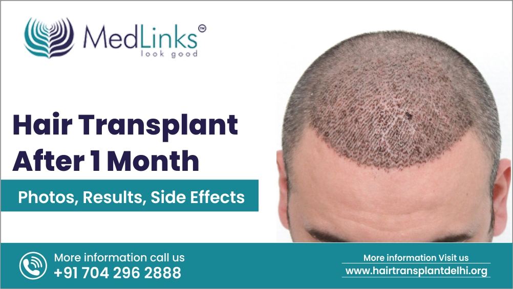 Hair Transplant After 1 Month: Photos, Results, Side Effects