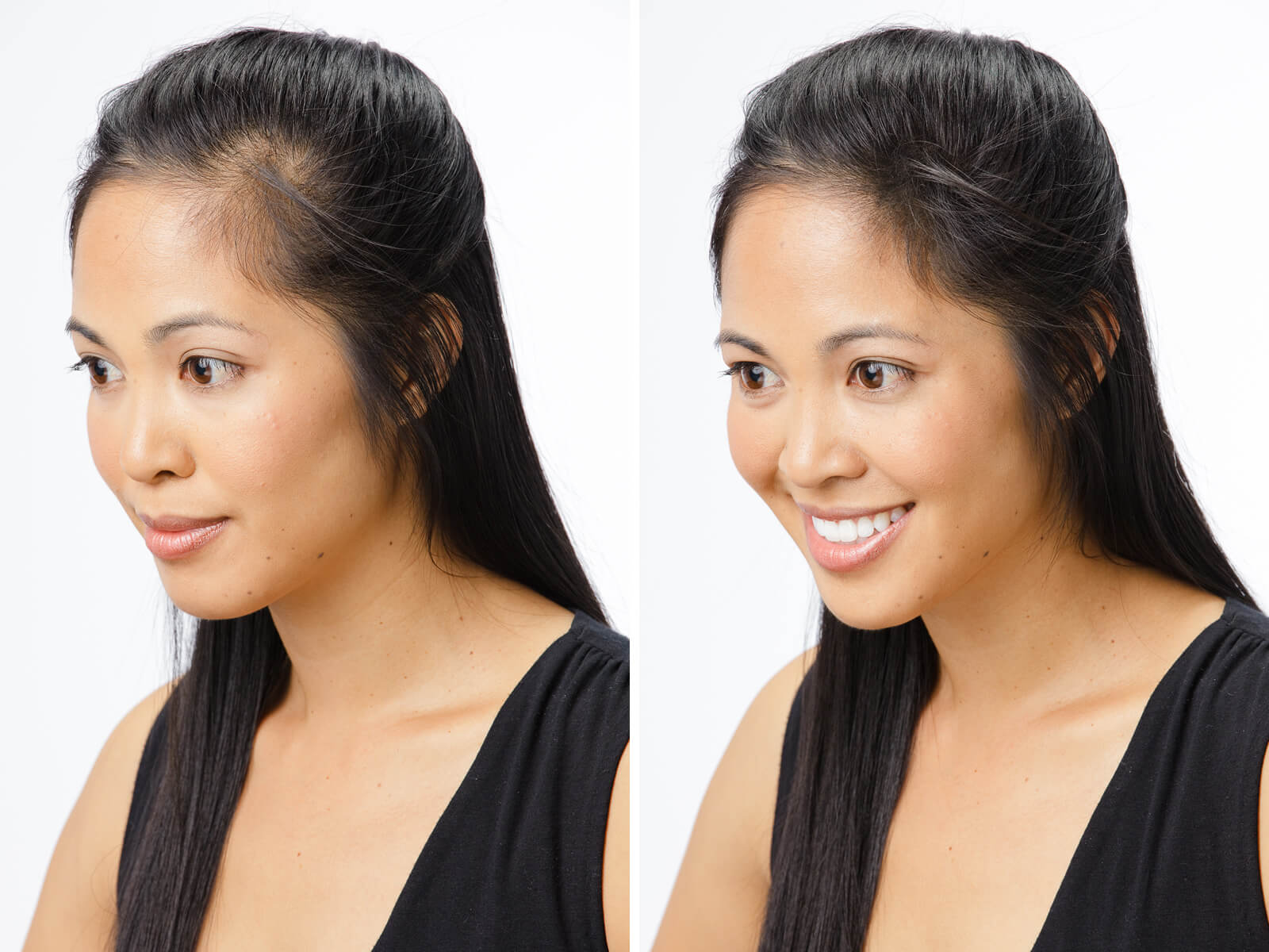 Types of Hair Loss in Women