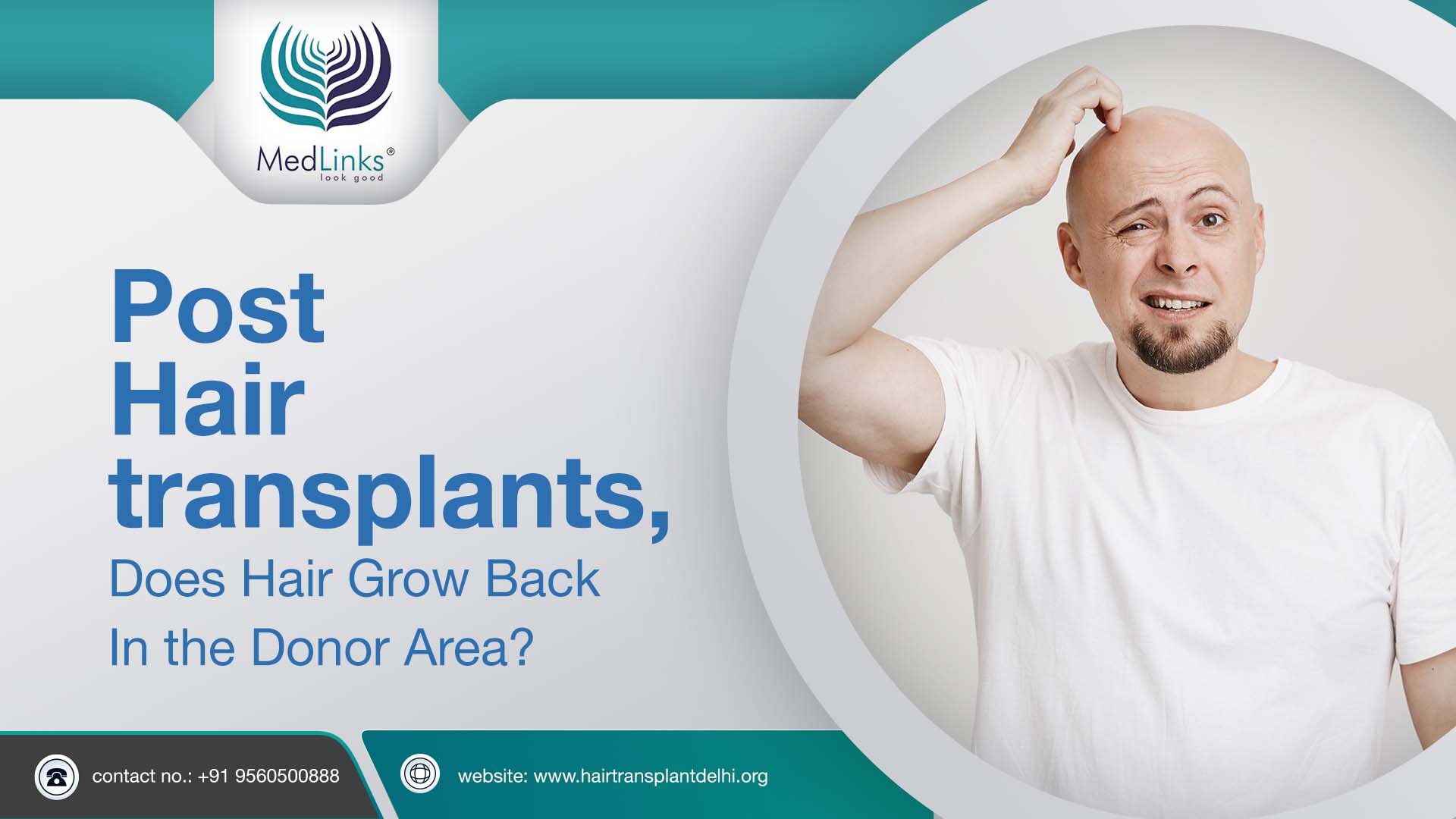 Post Hair transplant | Does Hair Grow Back In the Donor Area?