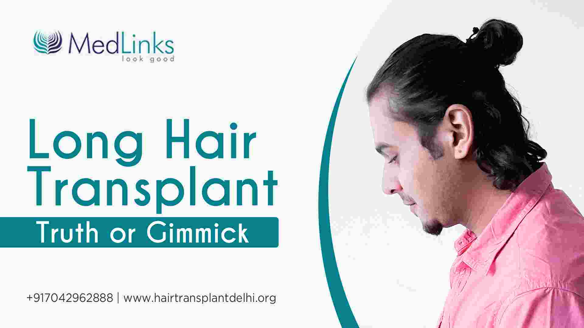Long Hair Transplant – Truth or Gimmick