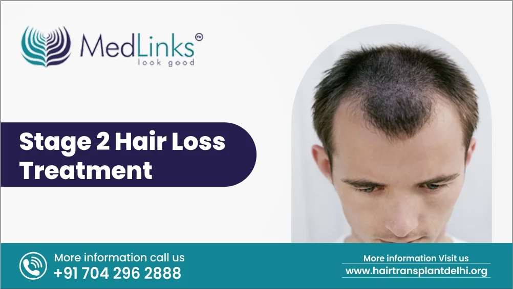 Stage 2 Hair Loss Treatment