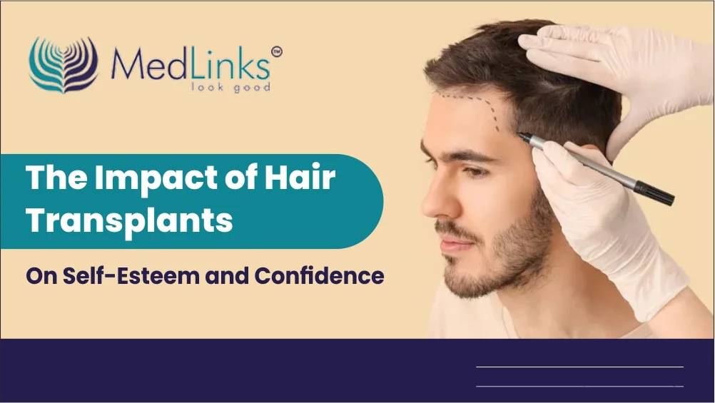 The Impact of Hair Transplants on Self-Esteem and Confidence