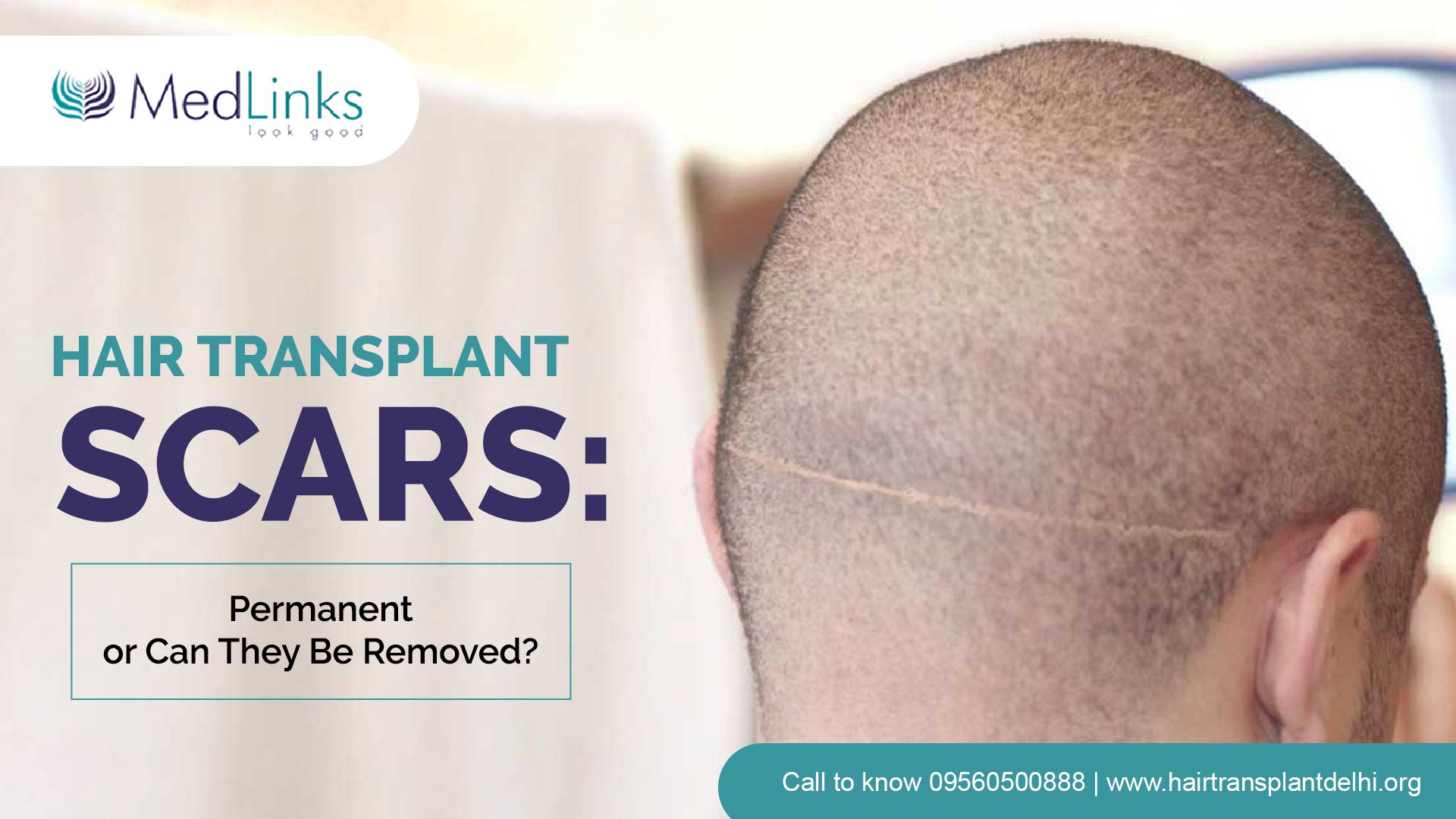 Hair Transplant Scars: Permanent or can they be removed? | MedLinks