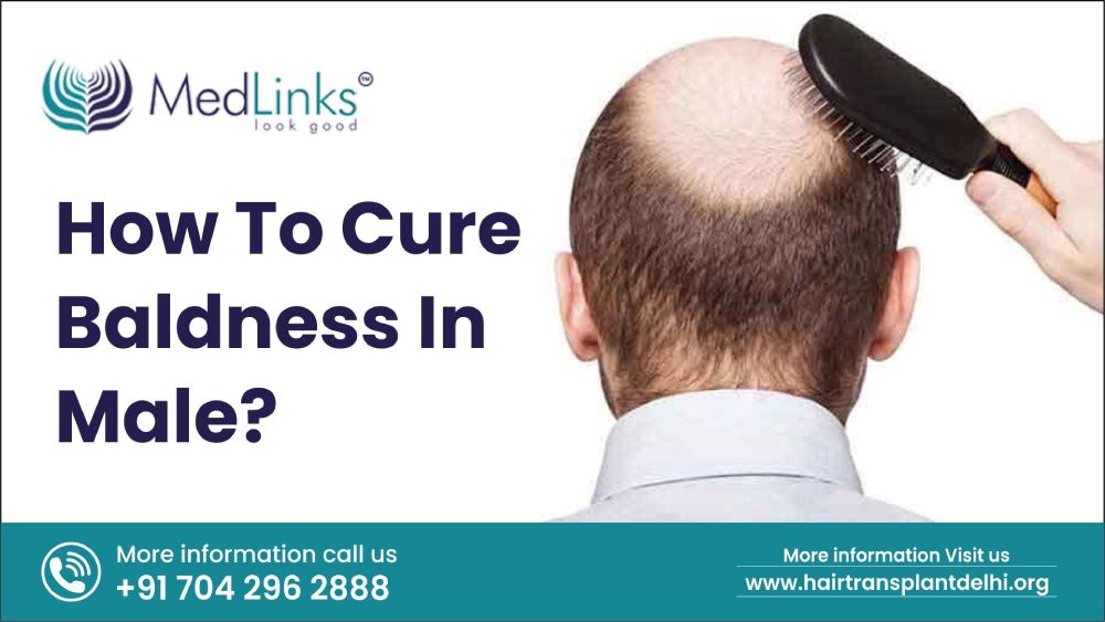 How to cure baldness in male?