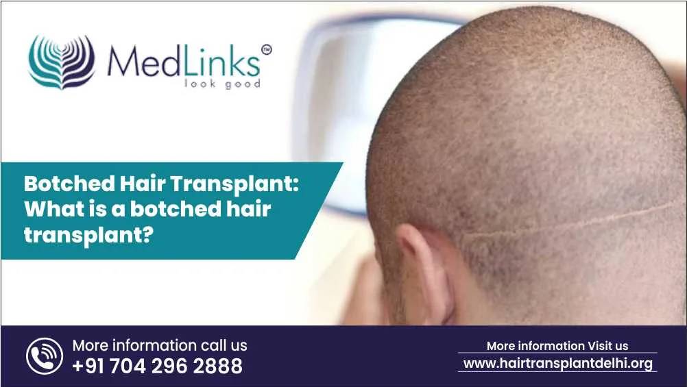 Botched Hair Transplant: What is a Botched Hair Transplant?