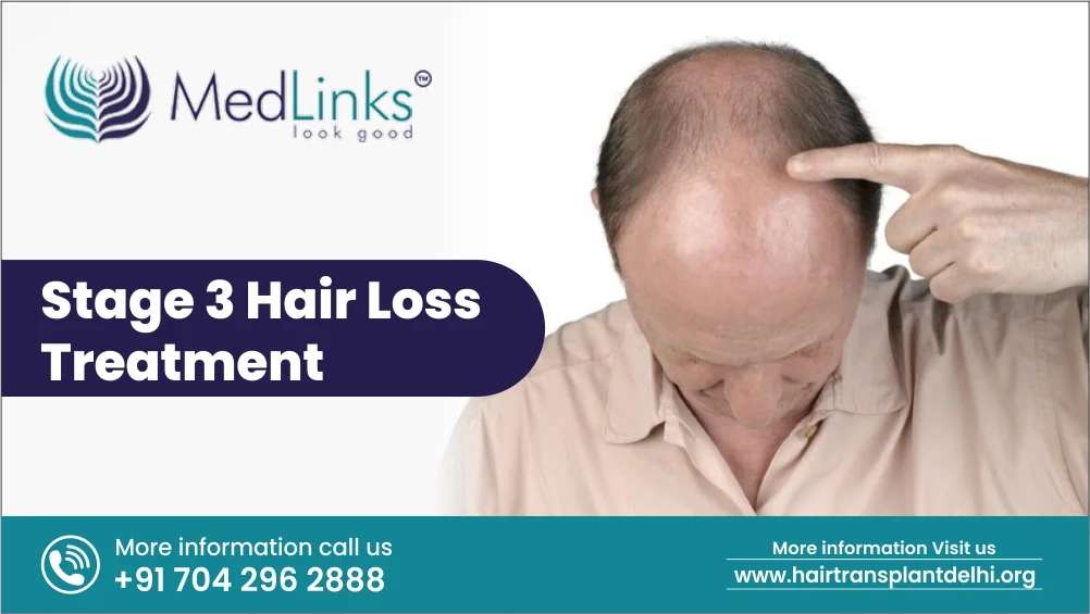 Stage 3 Hair Loss Treatment