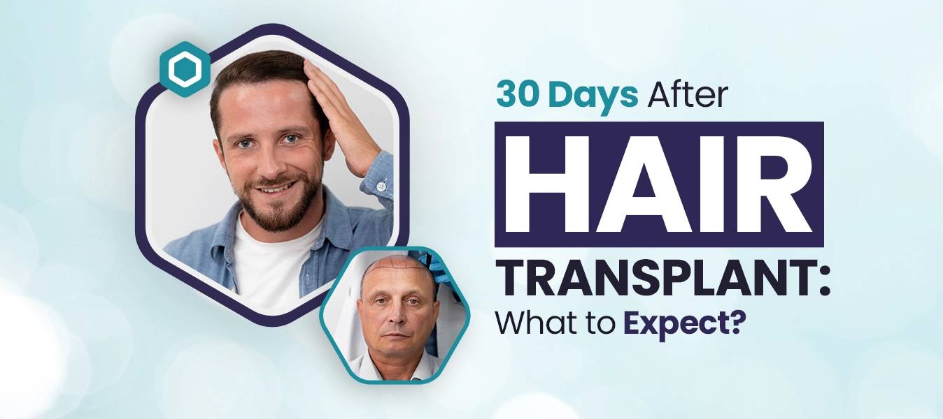 30 Days after Hair Transplant: What to Expect?