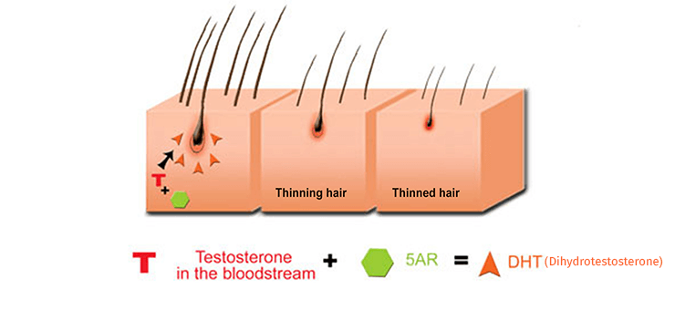 Is there any correlation between testosterone and hair loss