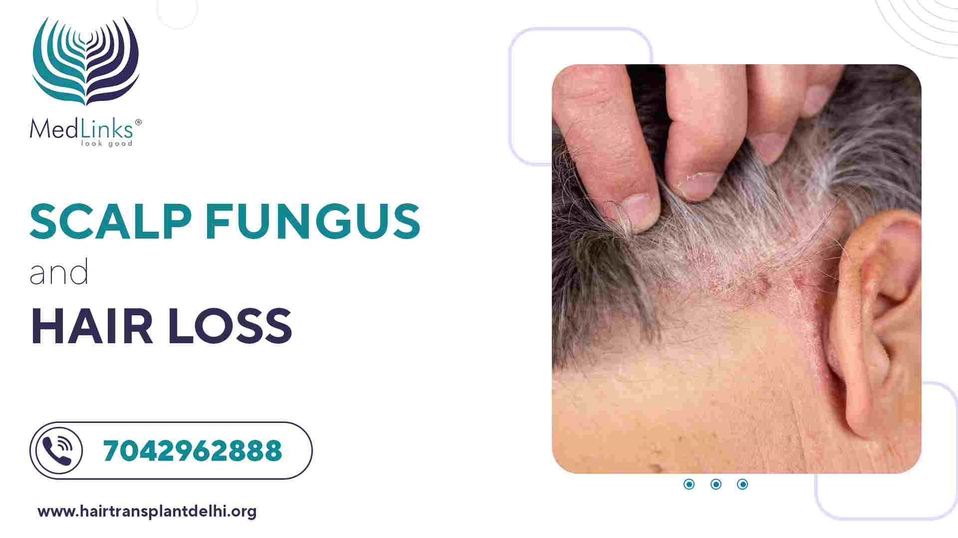Scalp Fungus and Hair Loss