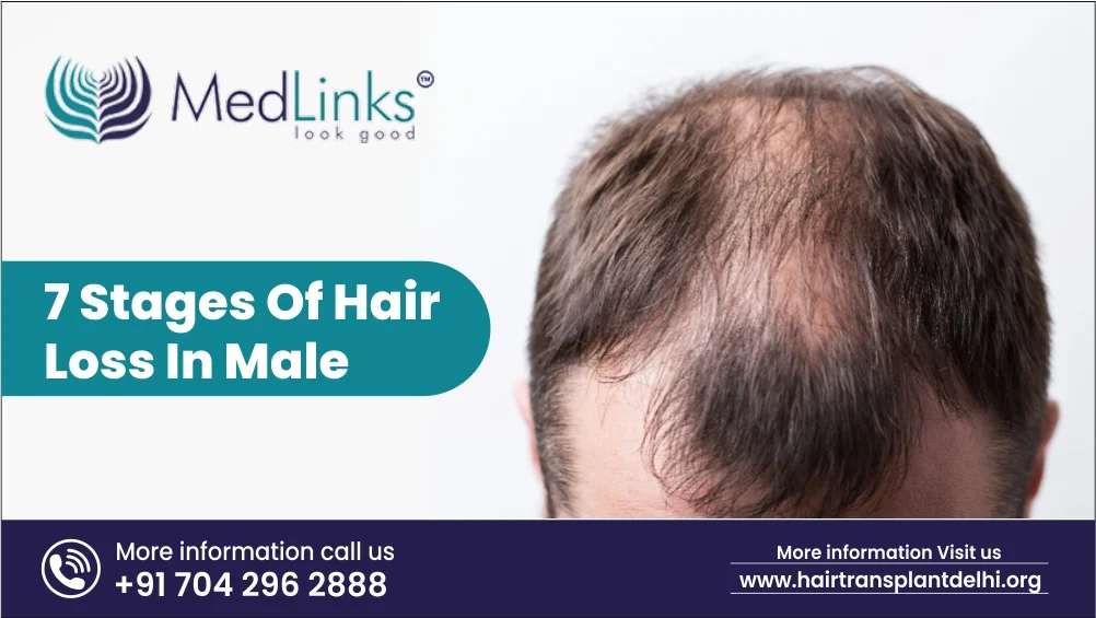 7 Stages of Hair Loss in Male: Male Pattern
