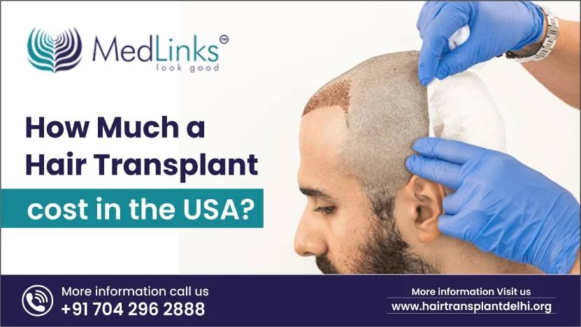 Hair Transplant Cost In USA | Medlinks