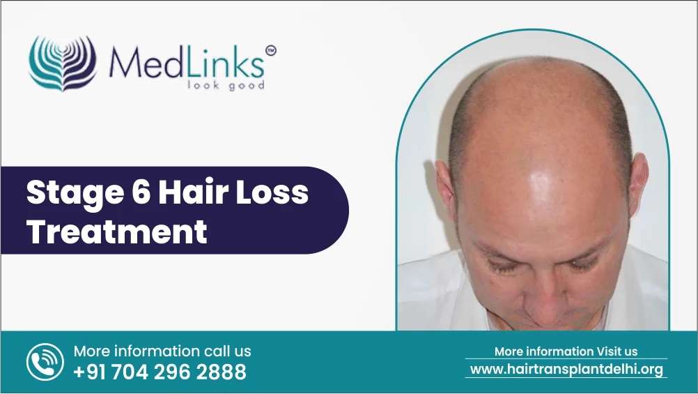Stage 6 Hair Loss Treatments