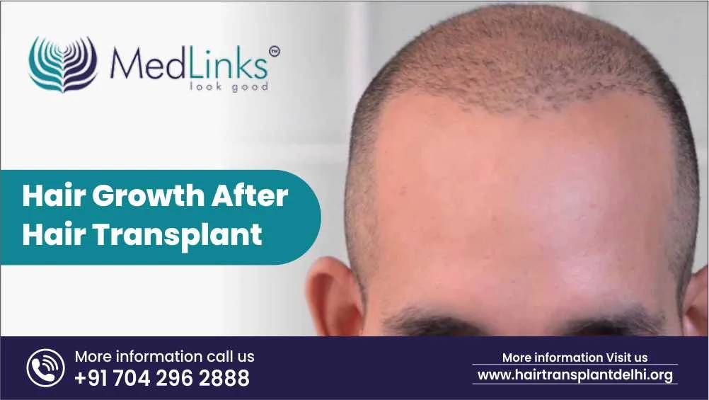 Hair Growth after Hair Transplant