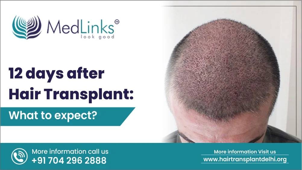 12 days after Hair Transplant: What to Expect?