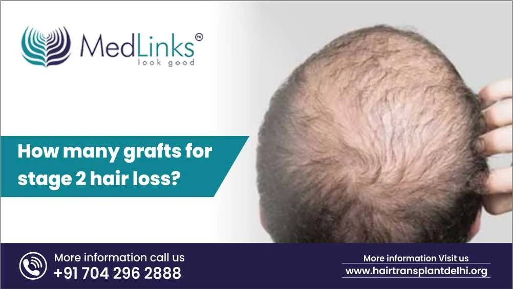 How Many Grafts for Stage 2 Hair Loss?